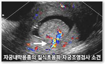 자궁내막용종의 질식초음파 자궁조영검사소견