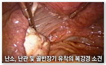 난소, 난관 및 골반장기 유착의 복강경 소견